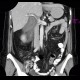 Acute cholecystitis on CT: CT - Computed tomography